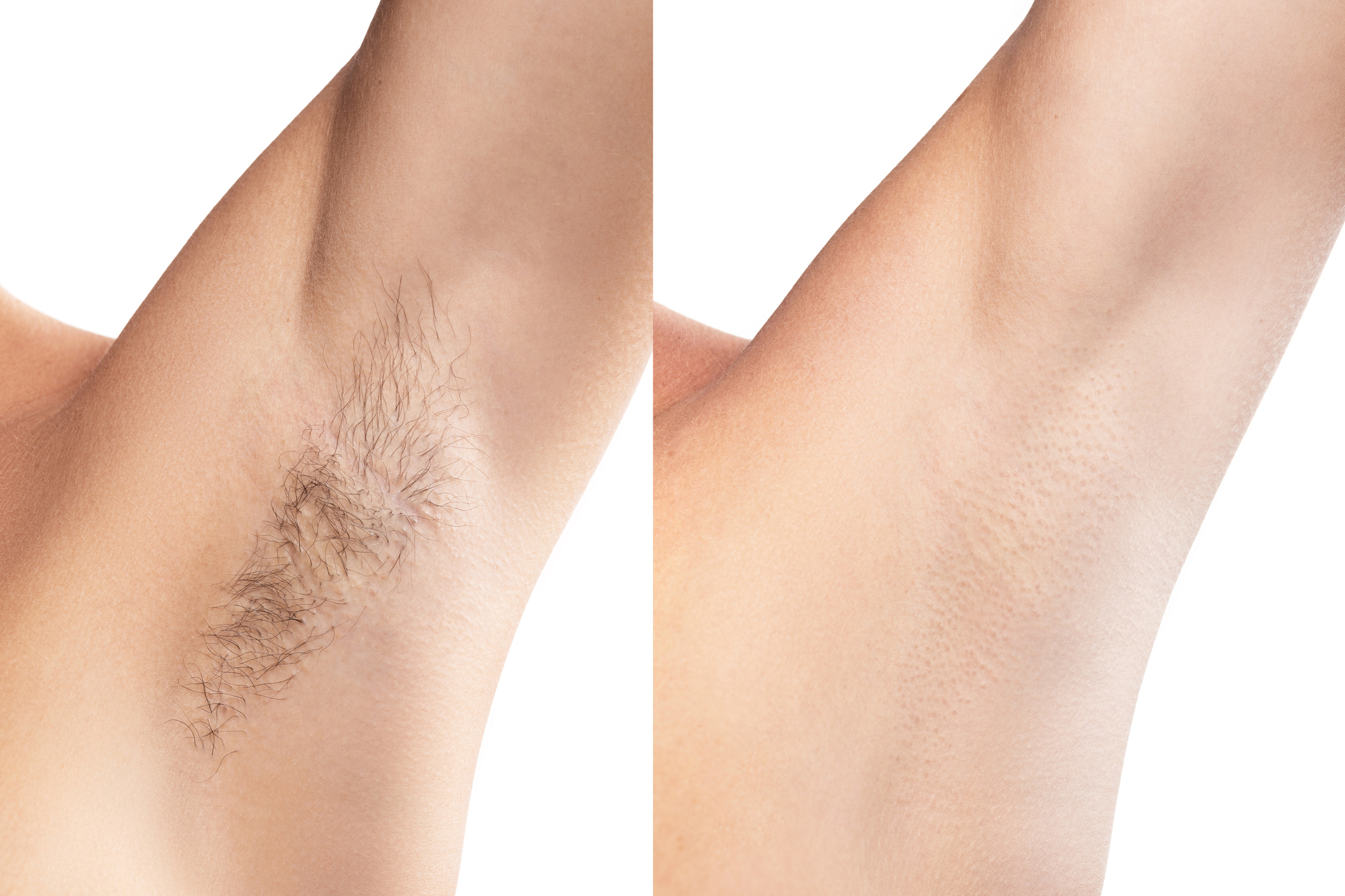 Laser hair removal – The full story